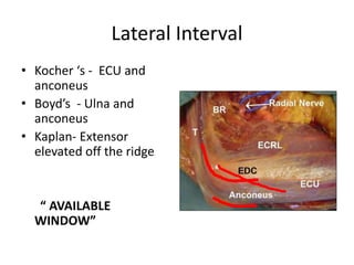Lateral Interval
• Kocher ‘s - ECU and
anconeus
• Boyd’s - Ulna and
anconeus
• Kaplan- Extensor
elevated off the ridge
“ AVAILABLE
WINDOW”
 