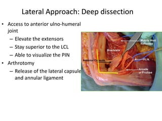 Lateral Approach: Deep dissection
• Access to anterior ulno-humeral
joint
– Elevate the extensors
– Stay superior to the LCL
– Able to visualize the PIN
• Arthrotomy
– Release of the lateral capsule
and annular ligament
 