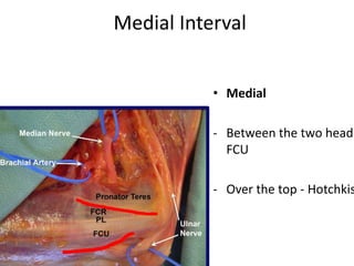 Medial Interval
• Medial
- Between the two head
FCU
- Over the top - Hotchkis
 