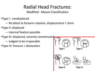 Radial Head Fractures:
Modified - Mason Classification
•Type I: nondisplaced
– No block to forearm rotation, displacement < 2mm
•Type II: displaced
– Internal fixation possible
•Type III: displaced, severely comminuted
– Judged to be irreparable
•Type IV: fracture + dislocation
 