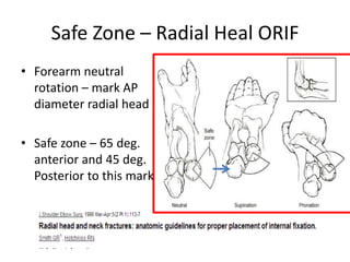 Safe Zone – Radial Heal ORIF
• Forearm neutral
rotation – mark AP
diameter radial head
• Safe zone – 65 deg.
anterior and 45 deg.
Posterior to this mark
 