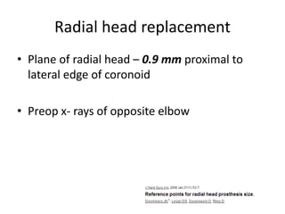 Radial head replacement
• Plane of radial head – 0.9 mm proximal to
lateral edge of coronoid
• Preop x- rays of opposite elbow
 