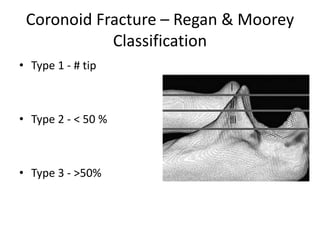 Coronoid Fracture – Regan & Moorey
Classification
• Type 1 - # tip
• Type 2 - < 50 %
• Type 3 - >50%
 