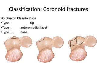 Classification: Coronoid fractures
•O’Driscoll Classification
•Type I: tip
•Type II: anteromedial facet
•Type III: base
 