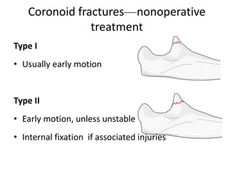 Coronoid fractures—nonoperative
treatment
Type I
• Usually early motion
Type II
• Early motion, unless unstable
• Internal fixation if associated injuries
 