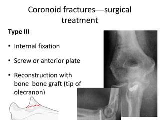 Coronoid fractures—surgical
treatment
Type III
• Internal fixation
• Screw or anterior plate
• Reconstruction with
bone bone graft (tip of
olecranon)
 