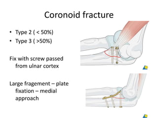 Coronoid fracture
• Type 2 ( < 50%)
• Type 3 ( >50%)
Fix with screw passed
from ulnar cortex
Large fragement – plate
fixation – medial
approach
 