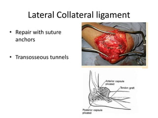 Lateral Collateral ligament
• Repair with suture
anchors
• Transosseous tunnels
 