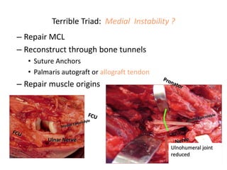 Terrible Triad: Medial Instability ?
– Repair MCL
– Reconstruct through bone tunnels
• Suture Anchors
• Palmaris autograft or allograft tendon
– Repair muscle origins
Ulnohumeral joint
reduced
 