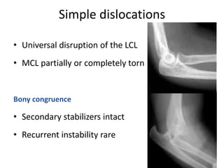 Simple dislocations
• Universal disruption of the LCL
• MCL partially or completely torn
Bony congruence
• Secondary stabilizers intact
• Recurrent instability rare
 