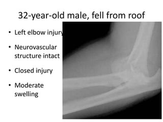 32-year-old male, fell from roof
• Left elbow injury
• Neurovascular
structure intact
• Closed injury
• Moderate
swelling
 