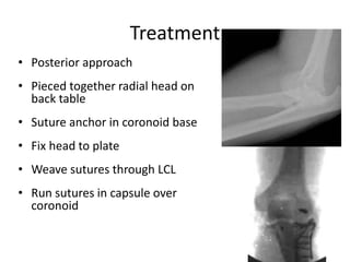 Treatment
• Posterior approach
• Pieced together radial head on
back table
• Suture anchor in coronoid base
• Fix head to plate
• Weave sutures through LCL
• Run sutures in capsule over
coronoid
 