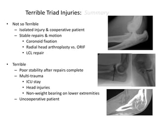 Terrible Triad Injuries: Summary
• Not so Terrible
– Isolated injury & cooperative patient
– Stable repairs & motion
• Coronoid fixation
• Radial head arthroplasty vs. ORIF
• LCL repair
• Terrible
– Poor stability after repairs complete
– Multi-trauma
• ICU stay
• Head injuries
• Non-weight bearing on lower extremities
– Uncooperative patient
 
