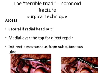 The “terrible triad”—coronoid
fracture
surgical technique
Access
• Lateral if radial head out
• Medial-over the top for direct repair
• Indirect percutaneous from subcutaneous
ulna
 