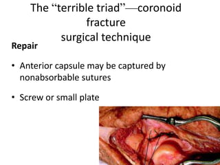 The “terrible triad”—coronoid
fracture
surgical technique
Repair
• Anterior capsule may be captured by
nonabsorbable sutures
• Screw or small plate
 