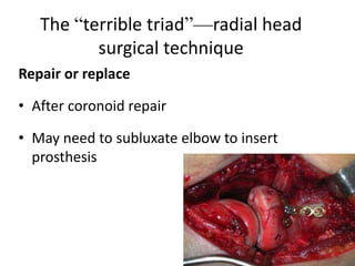 The “terrible triad”—radial head
surgical technique
Repair or replace
• After coronoid repair
• May need to subluxate elbow to insert
prosthesis
 