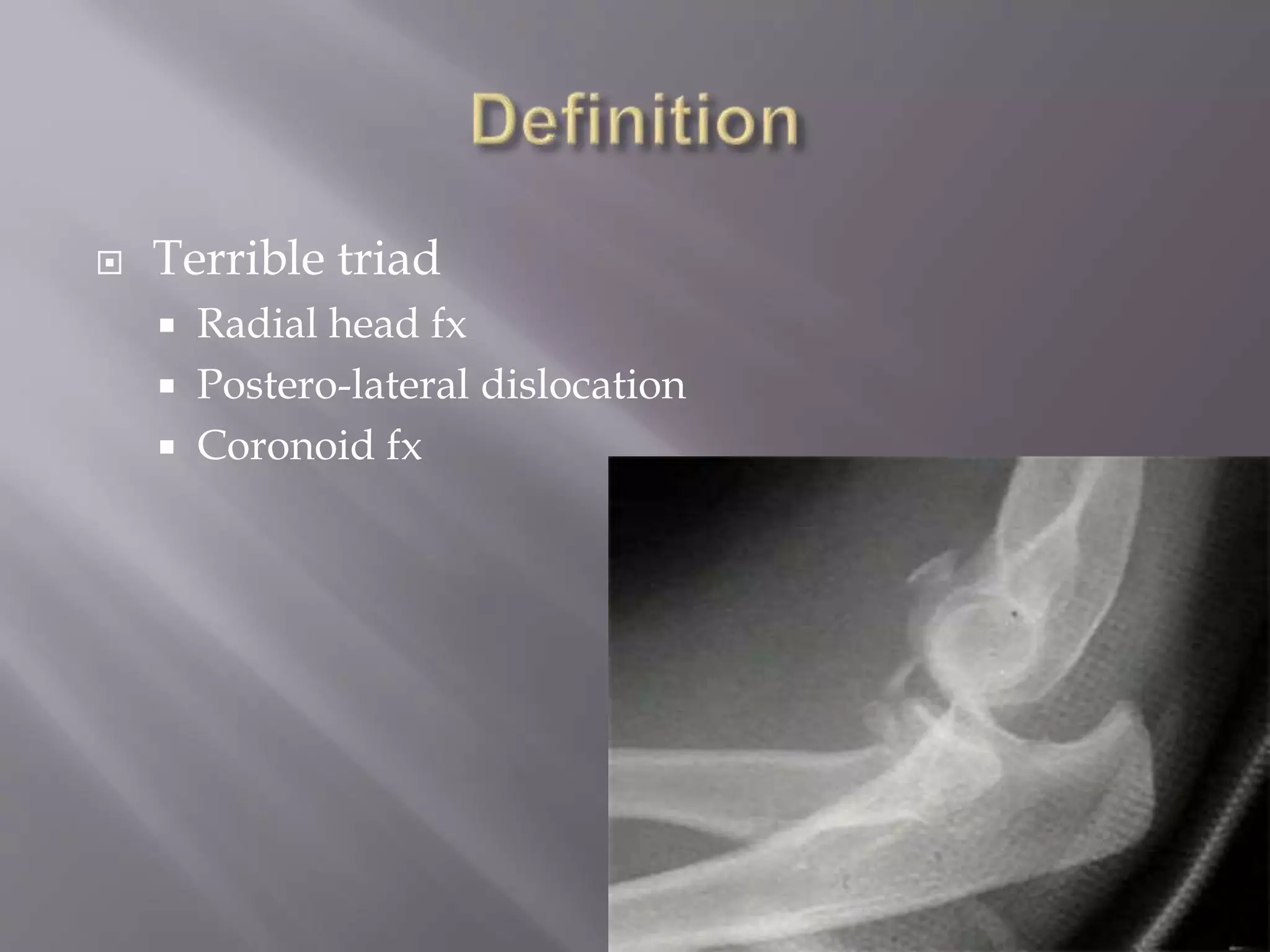  Terrible triad
Radial head fx
Postero-lateral dislocation
Coronoid fx