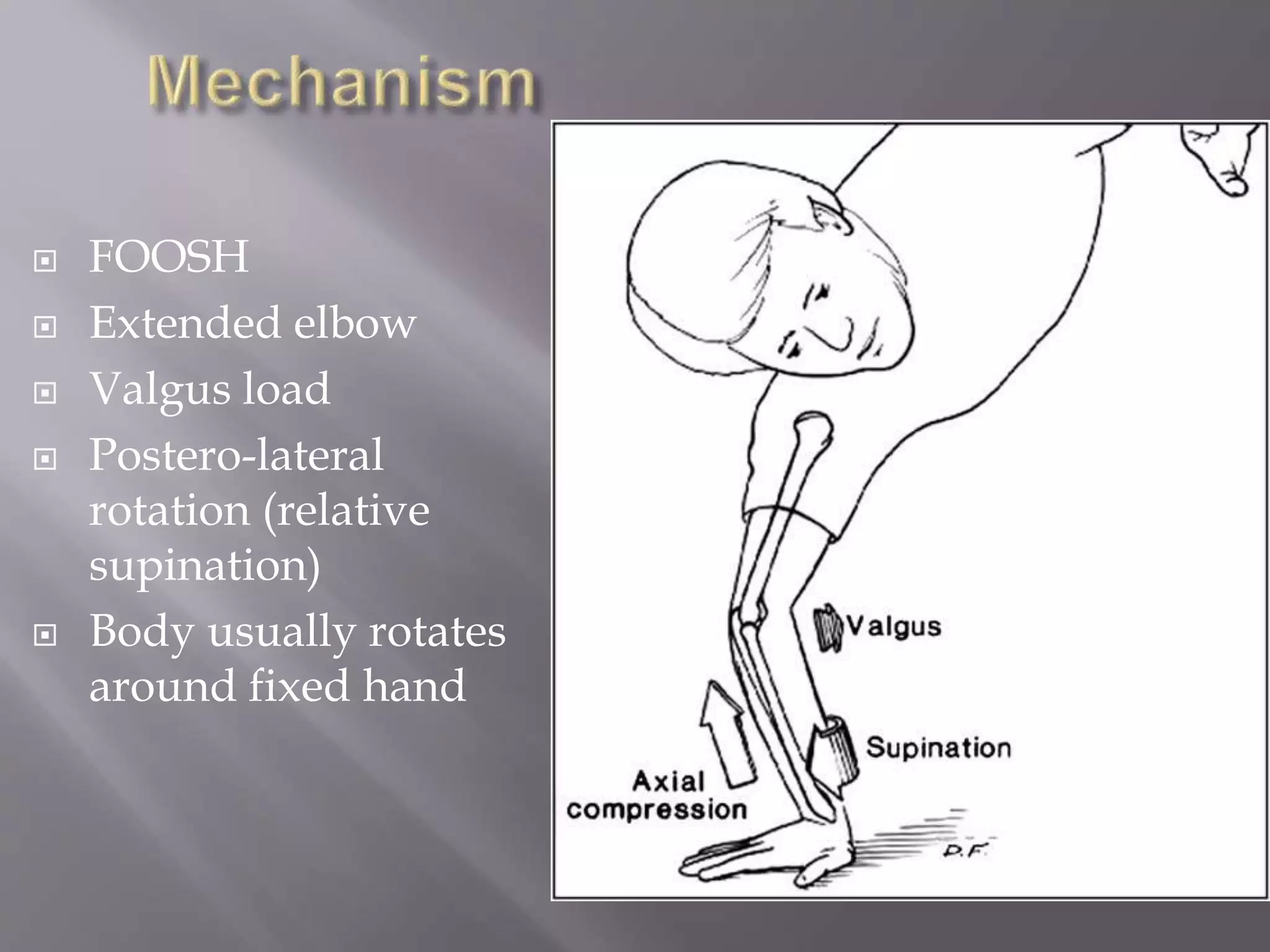  FOOSH
Extended elbow
Valgus load
Postero-lateral
rotation (relative
supination)
Body usually rotates
around fixed hand