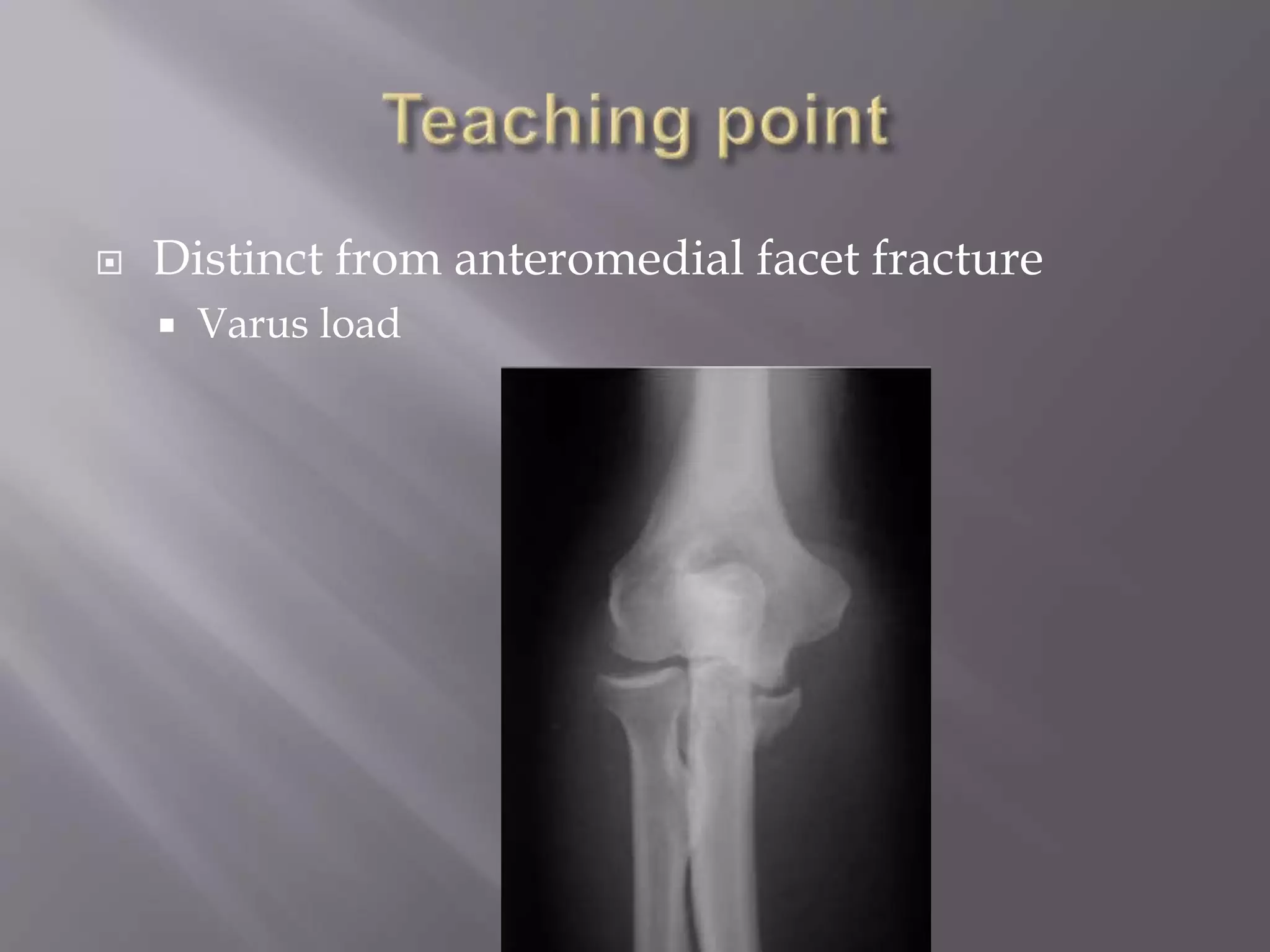  Distinct from anteromedial facet fracture
Varus load