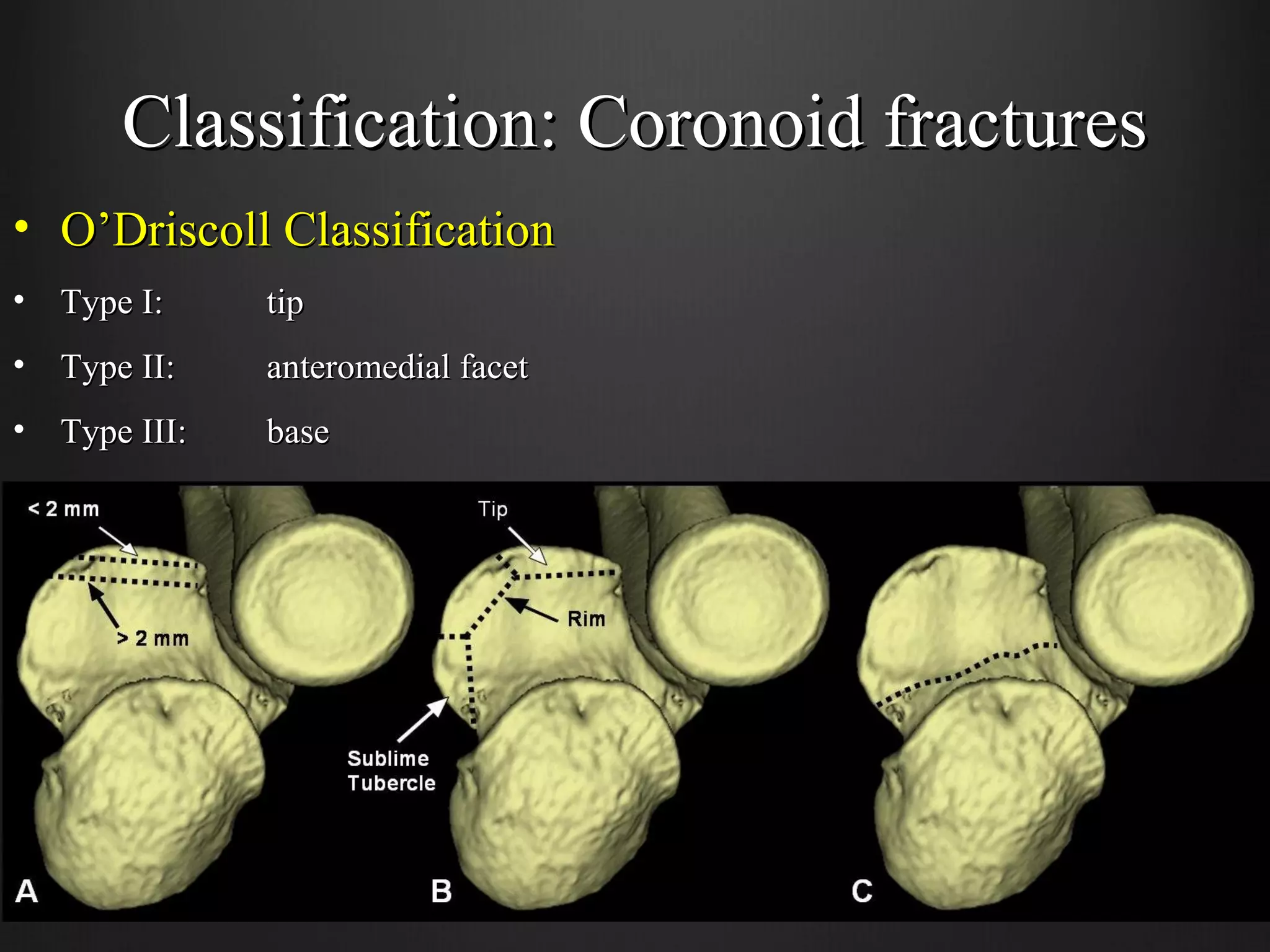 Coronoid Classification Terrible triad injuries - Hussain Algawahmed | PPT