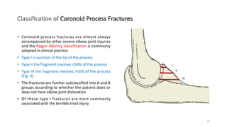 Terrible triad of the Elbow | PDF