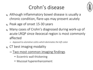 Crohn’s disease
 Although inflammatory bowel disease is usually a
chronic condition, flare-ups may present acutely
 Peak age of onset 15-30 years
 Many cases of Crohn’s diagnosed during work-up of
acute LRQP since ileocecal region is most commonly
affected
– Apposed to ulcerative colitis which dominates the left colon
 CT best imaging modality
– Two most common imaging findings
• Eccentric wall thickening
• Mucosal hyperenhancement
 
