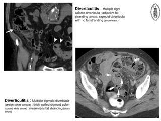 Diverticulitis : Multiple right
colonic diverticula ; adjacent fat
stranding (arrow) ; sigmoid diverticula
with no fat stranding (arrowheads)
Diverticulitis : Multiple sigmoid diverticula
(straight white arrows) ; thick walled sigmoid colon
(curved white arrow) ; mesenteric fat stranding (black
arrow)
 