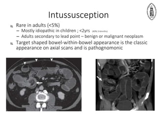 Intussusception
 Rare in adults (<5%)
– Mostly idiopathic in children ; <2yrs (40% 3-6mnths)
– Adults secondary to lead point – benign or malignant neoplasm
 Target shaped bowel-within-bowel appearance is the classic
appearance on axial scans and is pathognomonic
 