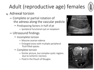 Adult (reproductive age) females
 Adnexal torsion
– Complete or partial rotation of
the adnexa along the vascular pedicle
• Predisposing factors in half of pt
– Ipsilateral functional cyst or neoplasm
– Ultrasound findings
• Incomplete torsion
– Massive ovarian edema
– Enlarged ovary with multiple peripheral
fluid filled spaces
• Complete torsion
– Similar picture, but complex cystic regions
due to ischemic necrosis
– Fluid in the Pouch of Douglas
 