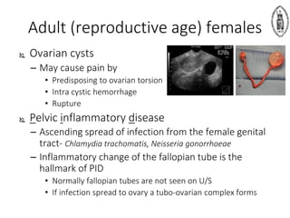 Adult (reproductive age) females
 Ovarian cysts
– May cause pain by
• Predisposing to ovarian torsion
• Intra cystic hemorrhage
• Rupture
 Pelvic inflammatory disease
– Ascending spread of infection from the female genital
tract- Chlamydia trachomatis, Neisseria gonorrhoeae
– Inflammatory change of the fallopian tube is the
hallmark of PID
• Normally fallopian tubes are not seen on U/S
• If infection spread to ovary a tubo-ovarian complex forms
 
