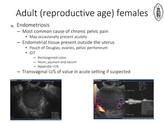 Adult (reproductive age) females
 Endometriosis
– Most common cause of chronic pelvic pain
• May occasionally present acutely
– Endometrial tissue present outside the uterus
• Pouch of Douglas, ovaries, pelvic peritoneum
• GIT
– Rectosigmoid colon
– Ileum, jejunum and cecum
– Appendix <1%
– Transvaginal U/S of value in acute setting if suspected
 