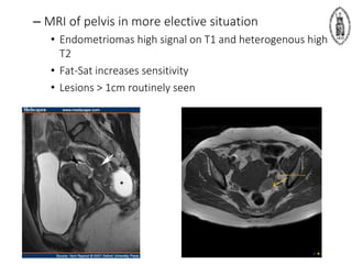 – MRI of pelvis in more elective situation
• Endometriomas high signal on T1 and heterogenous high
T2
• Fat-Sat increases sensitivity
• Lesions > 1cm routinely seen
 