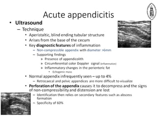 Acute appendicitis
 