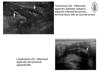 Transverse U/S : Inflammed
appendix (between calipers) ;
adjacent inflamed fat (arrow) ;
terminal ileum with air (curved arrow)
Longitudinal U/S : inflammed
appendix with proximal
appendicolith
 