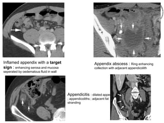 Inflamed appendix with a target
sign : enhancing serosa and mucosa
seperated by oedematous fluid in wall
Appendix abscess : Ring enhancing
collection with adjacent appendicolith
Appendicitis : dilated appendix
; appendicoliths ; adjacent fat
stranding
 