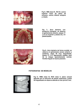 43
FOTOGRAFIAS DE MODELOS
Fig 6.- RMI clase III , RCI III, canino
superior fuera de plano de
oclusion, canino inferior ectopico
y rotado.
Fig 8.- Arco dentario de forma ovoidal, se
observa el apiñamiento severo anterior y
posterior, pieza 45 muy lingualizada,
piezas 37 y 47 ligeramente rotadas, piso
de la lengua aparentemente normal,
frenillo lingual en buena posición.
Fig 9.- RMD clase III, RCD clase II, plano oclusal
alterado por la extrucion de piezas superiores y pieza
45 lingualizado se observa además el over jet de 2 mm.
Fig 7.- Arco dentario con
tendencia triangular, se observa
el apiñamiento anterior, piezas 17
y 27 en erupción y piezas 22 y 12
palatinizados.
 