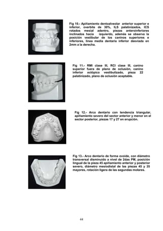 44
Fig 10.- Apiñamiento dentoalveolar anterior superior e
inferior, overbite de 30%, ILS palatinizados, ICS
rotados mesial adentro, piezas anteroinferiores
inclinados hacia izquierdo, además se observa la
posición vestibular de los caninos superiores e
inferiores, línea media dentaria inferior desviada en
2mm a la derecha.
Fig 11.- RMI clase III, RCI clase III, canino
superior fuera de plano de oclusión, canino
inferior ectópico vestibulizado, pieza 22
palatinizado, plano de oclusión aceptable.
Fig 12.- Arco dentario con tendencia triangular,
apiñamiento severo del sector anterior y menor en el
sector posterior, piezas 17 y 27 en erupción.
Fig 13.- Arco dentario de forma ovoide, con diámetro
transversal disminuido a nivel de 2das PM, posición
lingual de la pieza 45 apiñamiento anterior y posterior
severo, diámetro mesiodistal de las piezas 45 y 35
mayores, rotación ligera de las segundas molares.
 