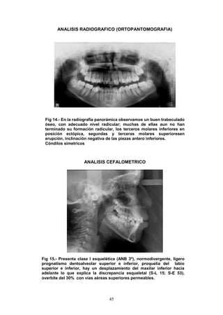 45
ANALISIS RADIOGRAFICO (ORTOPANTOMOGRAFIA)
ANALISIS CEFALOMETRICO
ANALISIS DE STEINER
TABLA Nº 1
Fig 14.- En la radiografía panorámica observamos un buen trabeculado
óseo, con adecuado nivel radicular; muchas de ellas aun no han
terminado su formación radicular, los terceros molares inferiores en
posición ectópica, segundas y terceras molares superioresen
erupción, inclinación negativa de las piezas antero inferiores.
Cóndilos simetricos
Fig 15.- Presenta clase I esquelética (ANB 3º), normodivergente, ligero
prognatismo dentoalveolar superior e inferior, proquelia del labio
superior e inferior, hay un desplazamiento del maxilar inferior hacia
adelante lo que explica la discrepancia esqueletal (S-L 15; S-E 53),
overbite del 30% con vías aéreas superiores permeables.
 