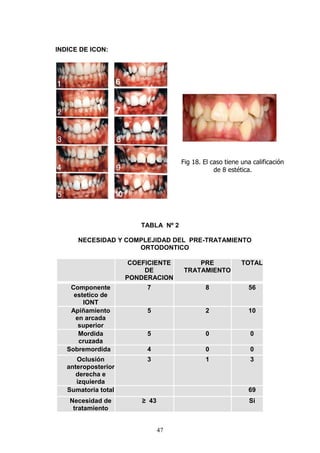 47
INDICE DE ICON:
TABLA Nº 2
NECESIDAD Y COMPLEJIDAD DEL PRE-TRATAMIENTO
ORTODONTICO
COEFICIENTE
DE
PONDERACION
PRE
TRATAMIENTO
TOTAL
Componente
estetico de
IONT
7 8 56
Apiñamiento
en arcada
superior
5 2 10
Mordida
cruzada
5 0 0
Sobremordida 4 0 0
Oclusión
anteroposterior
derecha e
izquierda
3 1 3
Sumatoria total 69
Necesidad de
tratamiento
≥ 43 Si
Fig 18. El caso tiene una calificación
de 8 estética.
 