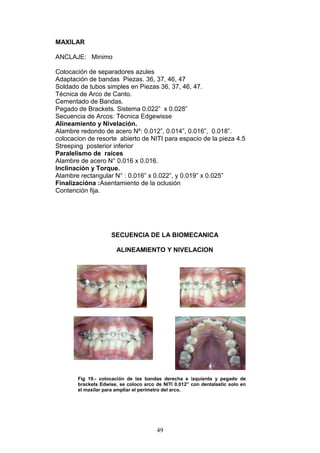 49
MAXILAR
ANCLAJE: Minimo
Colocación de separadores azules
Adaptación de bandas Piezas. 36, 37, 46, 47
Soldado de tubos simples en Piezas 36, 37, 46, 47.
Técnica de Arco de Canto.
Cementado de Bandas.
Pegado de Brackets. Sistema 0.022” x 0.028”
Secuencia de Arcos: Técnica Edgewisse
Alineamiento y Nivelación.
Alambre redondo de acero Nº: 0.012”, 0.014”, 0.016”, 0.018”.
colocacion de resorte abierto de NITI para espacio de la pieza 4.5
Streeping posterior inferior
Paralelismo de raíces
Alambre de acero N° 0.016 x 0.016.
Inclinación y Torque.
Alambre rectangular N° : 0.016” x 0.022”, y 0.019” x 0.025”
Finalizacióna :Asentamiento de la oclusión
Contención fija.
SECUENCIA DE LA BIOMECANICA
ALINEAMIENTO Y NIVELACION
Fig 19.- colocación de las bandas derecha e izquierda y pegado de
brackets Edwise, se coloco arco de NITI 0.012” con dentalastic solo en
el maxilar para ampliar el perímetro del arco.
 