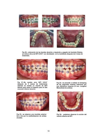50
Fig 20.- colocación de las bandas derecha e izquierda y pegado de brackets Edwise,
se coloco alrco de NITI 0.012” con dentalastic en la mandíbula después de 2 mese de
tratamieto.
Fig 21.-Se cambia arco NITI 0.014”
después de 4 meses de tratamiento
además se instala un resorte de NITI
abierto para hacer el espacio para el 2do
premolar inferior derecho.
Fig 22.- se procede a realizar el streeping
de las segundas molares inferiores por
sus diámetros mayores (9 mm. Longitud
Mesiodistal de ambos)
10-08-2010
Fig 23.- se observa una mordida anterior
bis a bis por la vestibulizacion de ambas
arcadas.
Fig 24.- podemos observar la acción del
resorte abierto de NITI
 