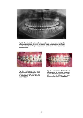 52
Fig 31.- Terminado la primera fase procedemos a tomar una radiografía
panorámica de control en la cual se observa que el paralelismo de las raíces
no esta adecuado por lo que se reposiciona los brackets en las respectivas
piezas dentales.
Fig 32.- Colocamos los arcos
rectangulares tanto superior como
inferior para corregir el torque que
se manifestara a partir del arco
0.019” X 0.025”
Fig 32.- procedemos finalmente al
asentamiento de mordida clocamos
un arco delgado en el superior 0.014”
NiTI y en el inferior un arco
rectangular de acero 0.019 X 0.025”
 