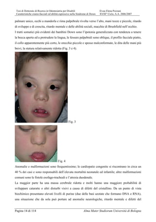Tesi di Dottorato di Ricerca in Odontoiatria per Disabili D.ssa Elena Pozzani
Caratteristiche cranio-facciali ed abilità espressive nella Sindrome di Down XVIII° Ciclo, A.A. 2006/2007
Pagina 14 di 114 Alma Mater Studiorum Università di Bologna
palmare unico, occhi a mandorla e rima palpebrale rivolta verso l’alto, mani tozze e piccole, ritardo
di sviluppo e di crescita, ritardo mentale e delle abilità sociali, macchie di Brushfield nell’occhio.
I tratti somatici più evidenti dei bambini Down sono l’ipotonia generalizzata con tendenza a tenere
la bocca aperta ed a protrudere la lingua, le fessure palpebrali sono oblique, il profilo facciale piatto,
il collo apparentemente più corto, le orecchie piccole e spesso malconformate, le dita delle mani più
brevi, la statura relativamente ridotta (Fig. 3 e 4).
Fig. 3
Fig. 4
Anomalie e malformazioni sono frequentissime; le cardiopatie congenite si riscontrano in circa un
40 % dei casi e sono responsabili dell’elevata mortalità neonatale ed infantile; altre malformazioni
comuni sono le fistole esofago-tracheali e l’atresia duodenale.
La maggior parte ha una massa cerebrale ridotta e molti hanno una maggiore probabilità di
sviluppare cataratte o altri disturbi visivi a causa di difetti del cristallino. Da un punto di vista
biochimico presentano elevati livelli di purine (due delle basi azotate che formano DNA e RNA),
una situazione che da sola può portare ad anomalie neurologiche, ritardo mentale e difetti del
 
