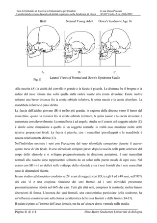 Tesi di Dottorato di Ricerca in Odontoiatria per Disabili D.ssa Elena Pozzani
Caratteristiche cranio-facciali ed abilità espressive nella Sindrome di Down XVIII° Ciclo, A.A. 2006/2007
Pagina 41 di 114 Alma Mater Studiorum Università di Bologna
Birth Normal Young Adult Down's Syndrome Age 16
A. B. C.
Lateral Views of Normal and Down's Syndrome Skulls
Alla nascita (A) la cavità del cervello è grande e la faccia è piccola. La distanza fra il bregma e la
radice del naso misura due volte quella dalla radice nasale alla cresta alveolare. Esiste inoltre
soltanto una breve distanza fra la cresta orbitale inferiore, la spina nasale e la cresta alveolare. La
mandibola infantile è quasi diritta.
La faccia dell'adulto giovane (B) è molto più grande, in ragione della discesa verso il basso del
mascellare, quindi la distanza fra la cresta orbitale inferiore, la spina nasale e la cresta alveolare è
aumentata considerevolmente. La mandibola è ad angolo. Anche se il cranio del soggetto adulto (C)
è simile come dimensione a quello di un soggetto normale, in realtà esso mantiene molte delle
relative proporzioni fetali. La faccia è piccola, con i mascellari iposviluppati e la mandibola è
ancora relativamente diritta (13).
Nell'individuo normale i seni con l'eccezione del seno sfenoidale compaiono durante il quarto-
quinto mese di vita fetale. Il seno sfenoidale compare presto dopo la nascita nella parte anteriore del
corpo dello sfenoide e si sviluppa progressivamente in direzione posteriore. I seni mascellari
normali alla nascita sono rappresentati soltanto da un solco nella parete nasale di ogni osso. Nel
cranio con SD vi è un deficit nello sviluppo dello sfenoide e sia i seni frontali che i seni mascellari
sono di dimensioni ridotte.
In uno studio cefalometrico condotto su 29 crani di soggetti con SD, tra gli 8 ed i 49 anni, nell’83%
dei casi vi è una cospicua riduzione dei seni frontali ed i seni sferoidali presentano
pneumatizzazione ridotta nel 66% dei casi. Tutti glii altri seni, compresa la mastoide, inoltre hanno
alterazioni di forma. L'assenza dei seni frontali, una caratteristica particolare della sindrome, ha
un'influenza considerevole sulla forma caratteristica delle ossa frontali e della fronte (14-15).
Il palato è piano all'interno dell’arco dentale, ma ha un' altezza dorso-ventrale nella media.
Fig.11
 