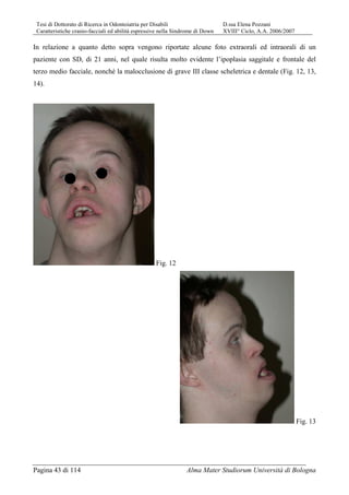 Tesi di Dottorato di Ricerca in Odontoiatria per Disabili D.ssa Elena Pozzani
Caratteristiche cranio-facciali ed abilità espressive nella Sindrome di Down XVIII° Ciclo, A.A. 2006/2007
Pagina 43 di 114 Alma Mater Studiorum Università di Bologna
In relazione a quanto detto sopra vengono riportate alcune foto extraorali ed intraorali di un
paziente con SD, di 21 anni, nel quale risulta molto evidente l’ipoplasia saggitale e frontale del
terzo medio facciale, nonché la malocclusione di grave III classe scheletrica e dentale (Fig. 12, 13,
14).
Fig. 12
Fig. 13
 
