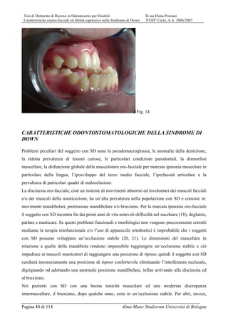 Tesi di Dottorato di Ricerca in Odontoiatria per Disabili D.ssa Elena Pozzani
Caratteristiche cranio-facciali ed abilità espressive nella Sindrome di Down XVIII° Ciclo, A.A. 2006/2007
Pagina 44 di 114 Alma Mater Studiorum Università di Bologna
Fig. 14
CARATTERISTICHE ODONTOSTOMATOLOGICHE DELLA SINDROME DI
DOWN
Problemi peculiari del soggetto con SD sono la pseudomacroglossia, le anomalie della dentizione,
la ridotta prevalenza di lesioni cariose, le particolari condizioni parodontali, la dismorfosi
mascellare, la disfunzione globale della muscolatura oro-facciale per marcata ipotonia muscolare in
particolare della lingua, l’iposviluppo del terzo medio facciale, l’iperlassità articolare e la
prevalenza di particolari quadri di malocclusioni.
La discinesia oro-facciale, cioè un insieme di movimenti abnormi ed involontari dei muscoli facciali
e/o dei muscoli della masticazione, ha un’alta prevalenza nella popolazione con SD e consiste in:
movimenti mandibolari, protrusione mandibolare e/o bruxismo. Per la marcata ipotonia oro-facciale
il soggetto con SD incontra fin dai primi anni di vita notevoli difficoltà nel succhiare (18), deglutire,
parlare e masticare. Se questi problemi funzionali e morfologici non vengono precocemente corretti
mediante la terapia miofunzionale e/o l’uso di apparecchi ortodontici è improbabile che i soggetti
con SD possano sviluppare un’occlusione stabile (20, 21). Le dimensioni del mascellare in
relazione a quelle della mandibola rendono impossibile raggiungere un’occlusione stabile e ciò
impedisce ai muscoli masticatori di raggiungere una posizione di riposo; quindi il soggetto con SD
cercherà inconsciamente una posizione di riposo confortevole eliminando l’interferenza occlusale,
digrignando od adottando una anormale posizione mandibolare, infine arrivando alla discinesia ed
al bruxismo.
Nei pazienti con SD con una buona tonicità muscolare ed una moderata discrepanza
intermascellare, il bruxismo, dopo qualche anno, esita in un’occlusione stabile. Per altri, invece,
 