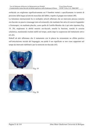 Tesi di Dottorato di Ricerca in Odontoiatria per Disabili D.ssa Elena Pozzani
Caratteristiche cranio-facciali ed abilità espressive nella Sindrome di Down XVIII° Ciclo, A.A. 2006/2007
Pagina 51 di 114 Alma Mater Studiorum Università di Bologna
orofaciale era migliorata significativamente nei 9 bambini trattati e specificamente in termini di
posizione della lingua ed attività muscolare del labbro, rispetto al gruppo non trattato (40).
La letteratura internazionale ha in molteplici articoli affermato che un intervento precoce motorio
oro-facciale sia passivo (massaggi intra ed extraorali), che mediante fasi attive di esercizi logopedici
e fisioterapici, sia mediante placche, come quella di Castillo-Morales che è qui sotto riportata (Fig.
19, 20), migliorano le abilità motorie oro-facciali, nonché la funzione, nonché la crescita
scheletrica, mantenendo risultati stabili nel tempo, anche dopo la sospensione del trattamento attivo
(41,42).
Hohoff ed altri affermano che il trattamento con la placca ha sicuramente un effetto positivo
sull’articolazione iniziale del linguaggio, ma perde il suo significato se non viene supportato nel
tempo da interventi riabilitativi per la motricità oro-facciale (43).
Fig. 19
Fig. 20
 
