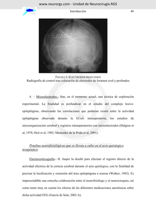 www.neurorgs.com - Unidad de Neurocirugía RGS
                                      Introducción                                       46




                          FIGURA 5. ELECTRODOS PROFUNDOS
   Radiografía de control tras colocación de electrodos de foramen oval y profundos




     4. – Microelectrodos.- Son, en el momento actual, una técnica de exploración

experimental. La finalidad es profundizar en el estudio del complejo lesivo-

epileptógeno, observando las correlaciones que pudieran existir entre la actividad

epileptógena    observada   durante    la   ECoG     intraoperatoria,   los   estudios   de

microorganización cerebral y registros intraoperatorios con microelectrodos (Halgren et

al, 1978; Heit et al, 1985; Menéndez de la Prida et al, 2001).



     Pruebas neurofisiológicas que se llevan a cabo en el acto quirúrgico
terapéutico

     Electrocorticografía.- H. Jasper la diseñó para efectuar el registro directo de la

actividad eléctrica de la corteza cerebral durante el acto quirúrgico, con la finalidad de

precisar la localización y extensión del área epileptógena a resecar (Walker, 1982). Es

imprescindible una estrecha colaboración entre el neurofisiólogo y el neurocirujano, así

como tener muy en cuenta los efectos de las diferentes medicaciones anestésicas sobre

dicha actividad EEG (García de Sola, 2003 A).
 