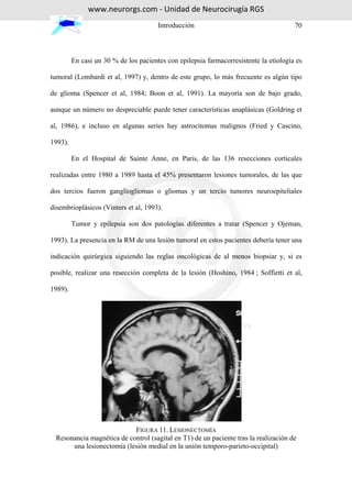 www.neurorgs.com - Unidad de Neurocirugía RGS
                                       Introducción                                    70



         En casi un 30 % de los pacientes con epilepsia farmacorresistente la etiología es

tumoral (Lombardi et al, 1997) y, dentro de este grupo, lo más frecuente es algún tipo

de glioma (Spencer et al, 1984; Boon et al, 1991). La mayoría son de bajo grado,

aunque un número no despreciable puede tener características anaplásicas (Goldring et

al, 1986), e incluso en algunas series hay astrocitomas malignos (Fried y Cascino,

1993).

         En el Hospital de Sainte Anne, en Paris, de las 136 resecciones corticales

realizadas entre 1980 a 1989 hasta el 45% presentaron lesiones tumorales, de las que

dos tercios fueron gangliogliomas o gliomas y un tercio tumores neuroepiteliales

disembrioplásicos (Vinters et al, 1993).

         Tumor y epilepsia son dos patologías diferentes a tratar (Spencer y Ojeman,

1993). La presencia en la RM de una lesión tumoral en estos pacientes debería tener una

indicación quirúrgica siguiendo las reglas oncológicas de al menos biopsiar y, si es

posible, realizar una resección completa de la lesión (Hoshino, 1984 ; Soffietti et al,

1989).




                            FIGURA 11. LESIONECTOMÍA
  Resonancia magnética de control (sagital en T1) de un paciente tras la realización de
       una lesionectomía (lesión medial en la unión temporo-parieto-occipital)
 
