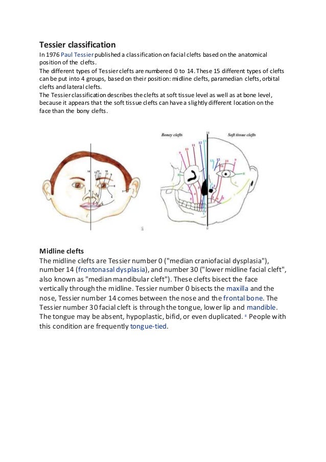 Tessier classification for orthodontist by Almuzian